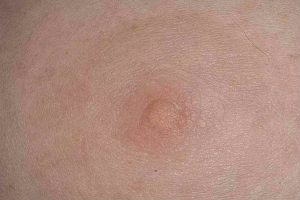 Коричневая корочка на соске, покалывания