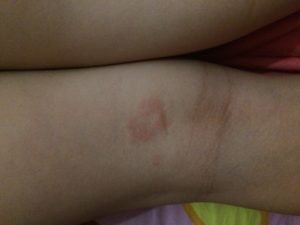 Пятна на сгибах рук