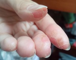 После наращивания ногтей чешутся пальцы