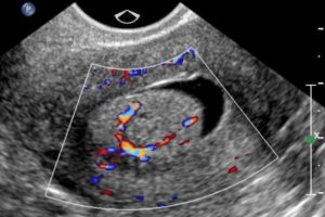 Рак шейки матки 3 степени по УЗИ