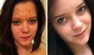 Появились прыщи при приеме Джес