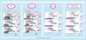 Остеохондроз шоп и поп