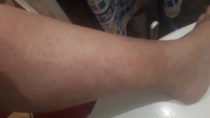 Чешутся ноги после душа