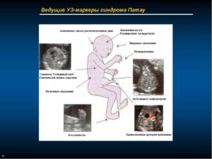 Эхо-маркеры ХА