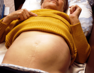 Увеличена селезенки при беременности