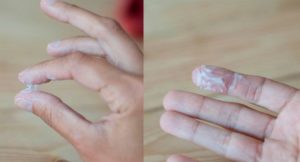 Белые выделения и сгустки из влагалища