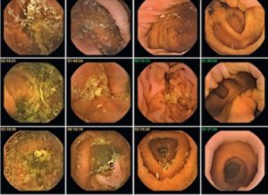 Кал не доходит до прямой кишки