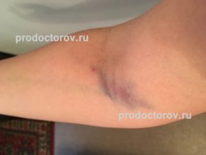 Шишка после взятия крови из вены