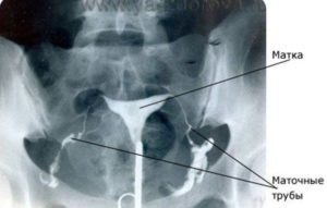 Задержка после проверки проходимости маточных труб