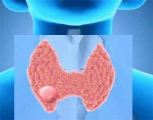 Узлы щитовидной железы