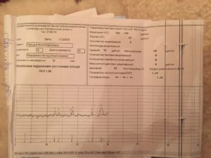 Индекс реактивности при КТГ