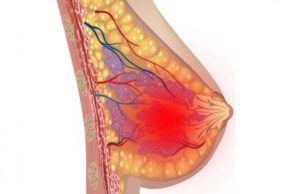 После замершей беременности уплотнение в верху левой молочной железы