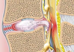 Секвестрированная грыжа