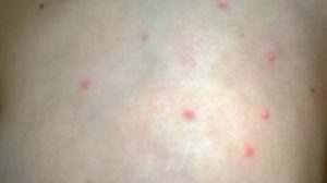 Красные пятна на голове не чешутся не зудятся