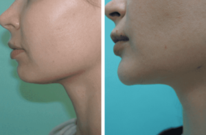 Осложнения после коррекции подбородка филлером