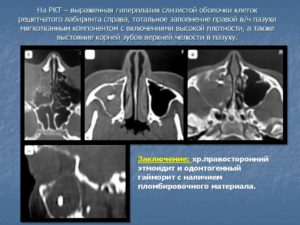 Утолщение слизистой в/ч, клеток решетчатого лабиринта
