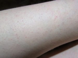 Чешутся ноги после душа