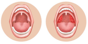 Хронически тонзиллит