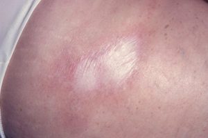 Очаговая склеродермия, обследование