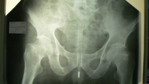 Застрял предмет в прямой кишке