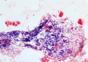 Гарднерелла