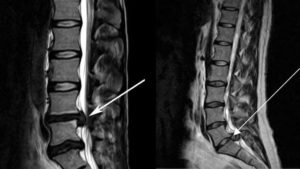 Киста и протрузии в пояснично-крестцовом отделе позвоночника