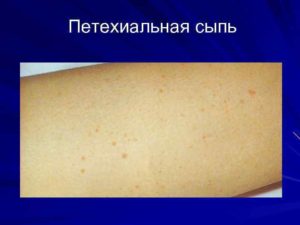 Геморрагическая сыпь при лейкозе