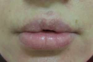 Фиброз после введения филлера в губы