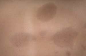 Очаговая склеродермия, обследование