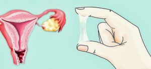 Нет выделений во влагалище