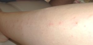 Зуд и прыщи на животе, ногах, руках