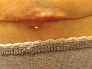 Осталась нитка после снятия швов