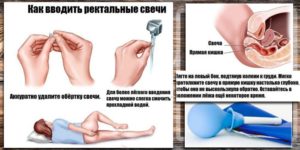 Нужно ли вставлять свечу заново при геморрое после туалета