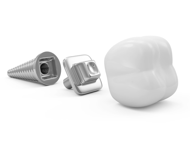 Показания к имплантации зубов: когда стоит рассмотреть вариант