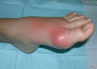 Подагра Подагра