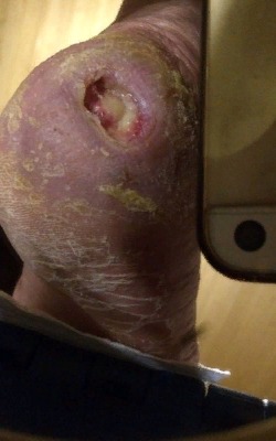 Первый приезд врача к пациенту. Влажный гнойный пролежень. Без оказания медицинской помощи картина заболевания будет ухудшаться Image