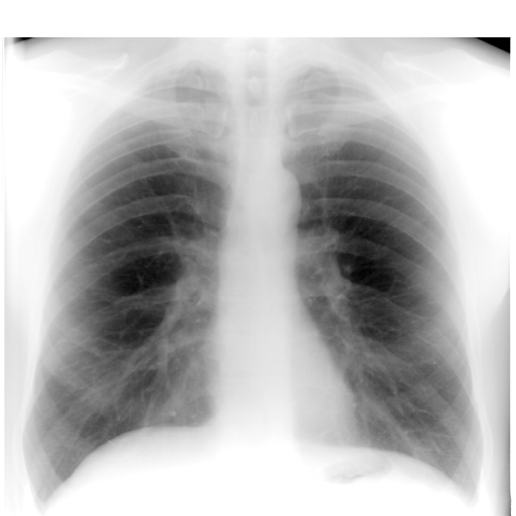 Хронический бронхит