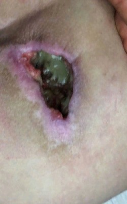 Пролежень на копчике на стадии обращения за помощью. Обильное поражение с большим количеством гноя. Image