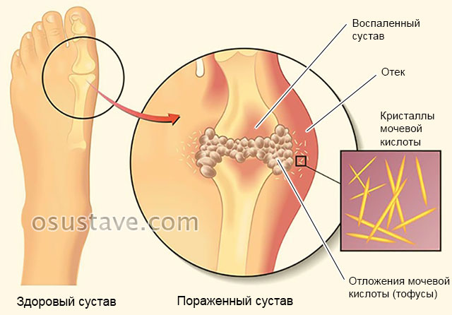 накопление и отложение мочевой кислоты в суставе при подагре