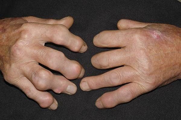 тяжелая форма подагры