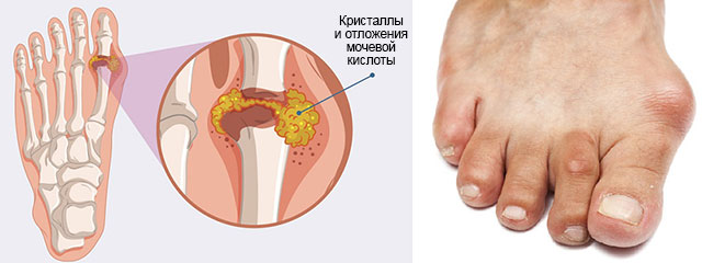 пораженный сустав большого пальца ноги