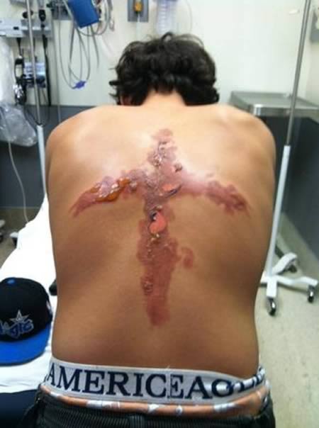 Как получить ожог льдом и солью