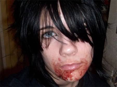 Как получить ожог льдом и солью