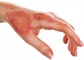 Избавится от пятен после ожогов Избавится от пятен после ожогов thumbnail