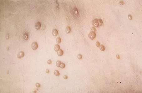 Ожог от марганцовки полового члена как лечить