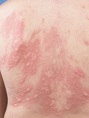 Âîçâðàùåíèå âðà÷à êîìáóñòèîëîãà Êîìáóñòèîëîã, Îæîã, Ìåäèöèíà, Äëèííîïîñò