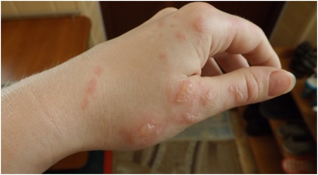 Мазь спасатель от ожога борщевиком