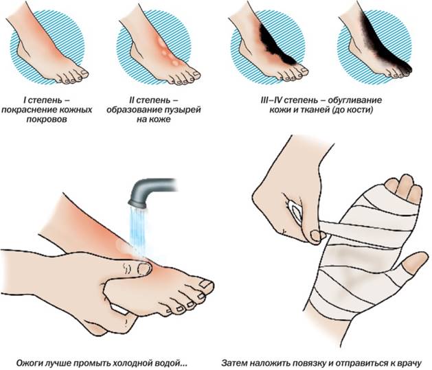 Принципы лечения ожогов и ожоговой болезни