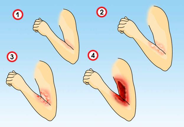 Принципы лечения ожогов и ожоговой болезни