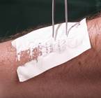 Принципы лечения ожогов и ожоговой болезни